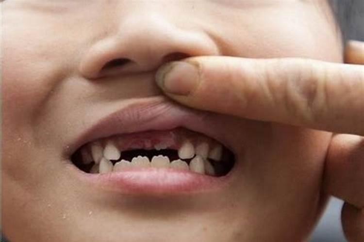 小孩梦到掉牙齿是什么预兆